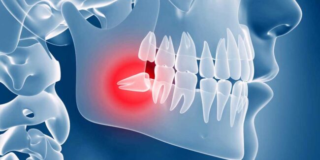 denti-giudizio-1200×600