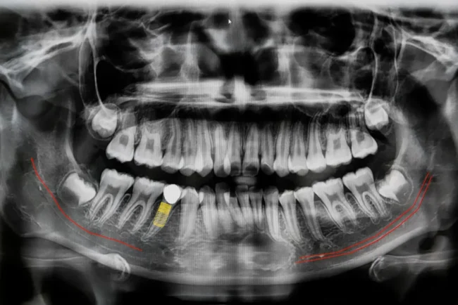 radiografia-dentale-studio-odontoiatrico-maurizio-giussani-milano-1024×683
